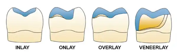 Inlay onblay overlay veneerlay Inlay onlay overlay veneerlay